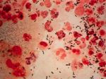 24-1366789542-gonorrhea-600[1]