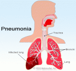 pneumonia[1]