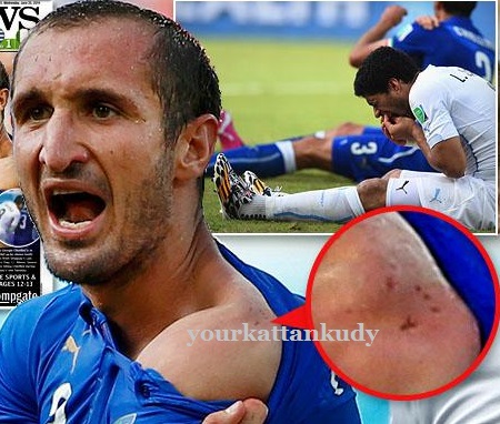 suarez bite