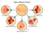 Breast-cancer